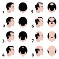Stages of baldness according to the Norwood scale.